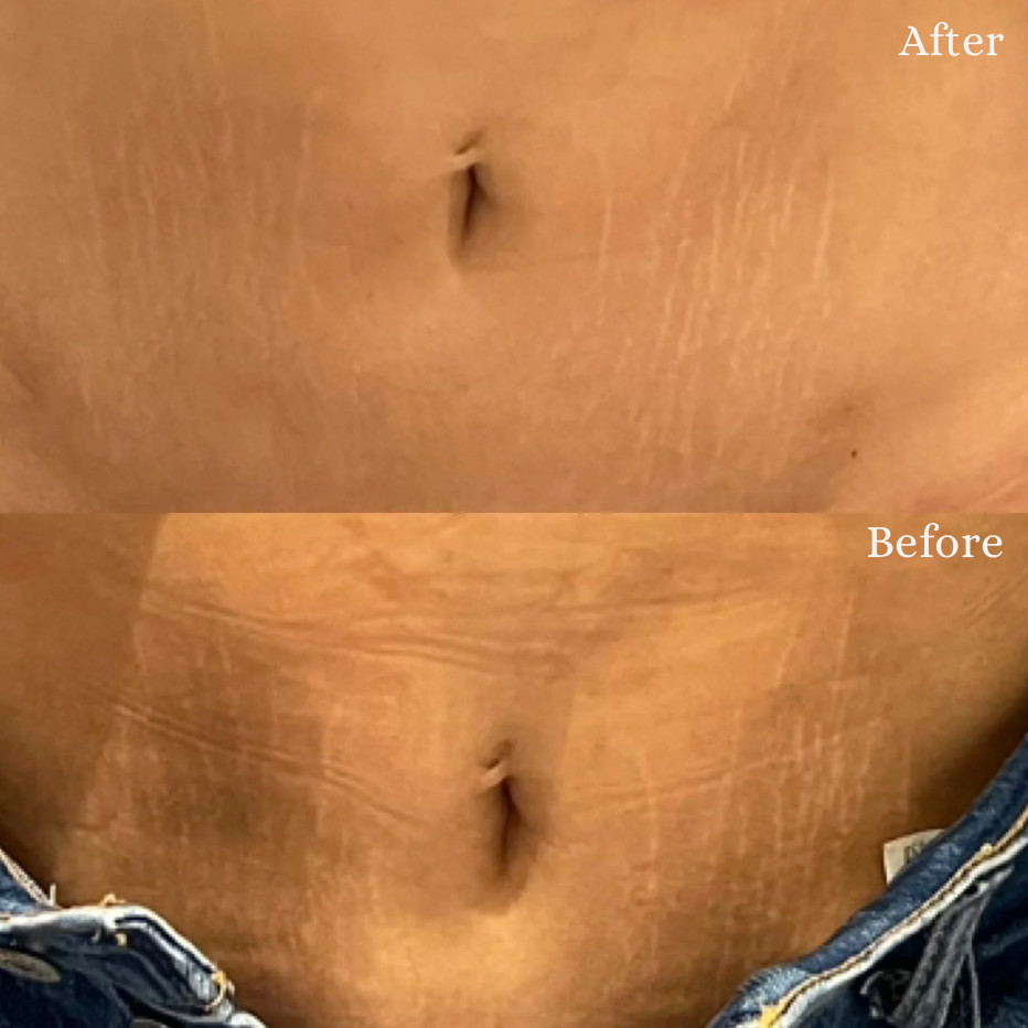 Två sida vid sida bilder av en persons mittparti. Den översta bilden märkt "Efter" visar slätare hud, medan den nedre bilden märkt "Före" visar mer synliga bristningar.
