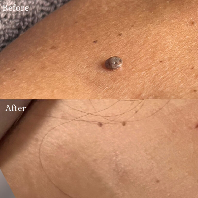 Närbildsjämförelse av hud före och efter mullvadsborttagning. Toppen visar en upphöjd mullvad; botten visar slät hud med läkningsmärken.