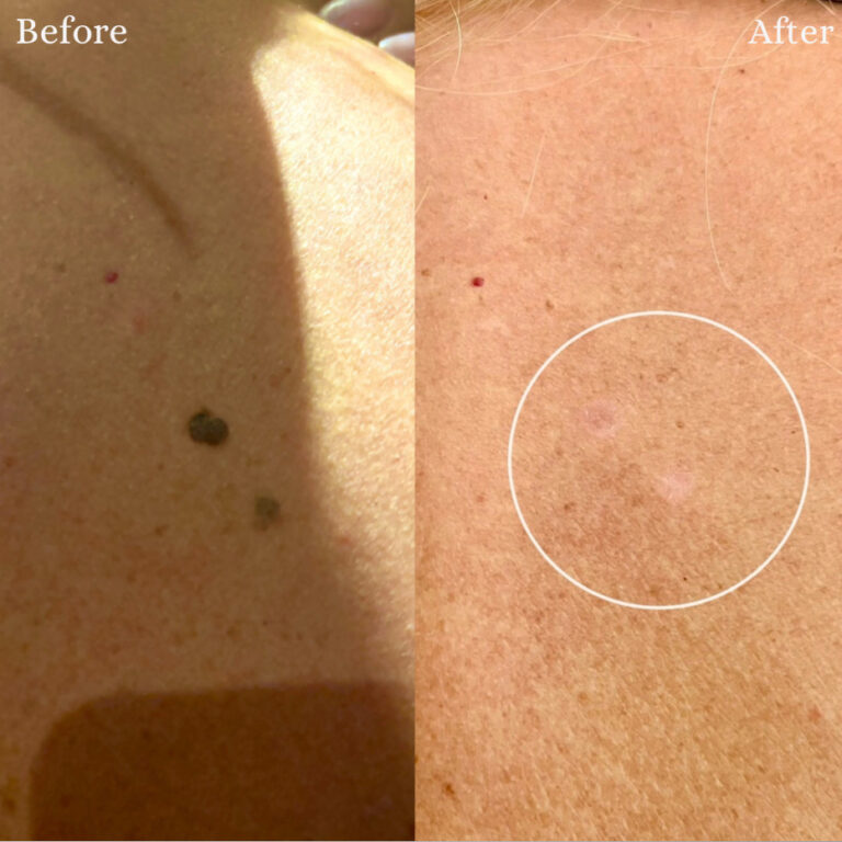 Före- och efterbilder som visar borttagningen av två mörka hudfläckar.