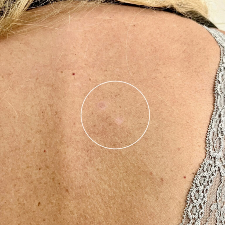 Närbild av en persons övre rygg med fokus på två små, ljusa fläckar i en cirkel. Huden ser lätt solbränd ut med några fräknar och en spetsrem syns på axeln.