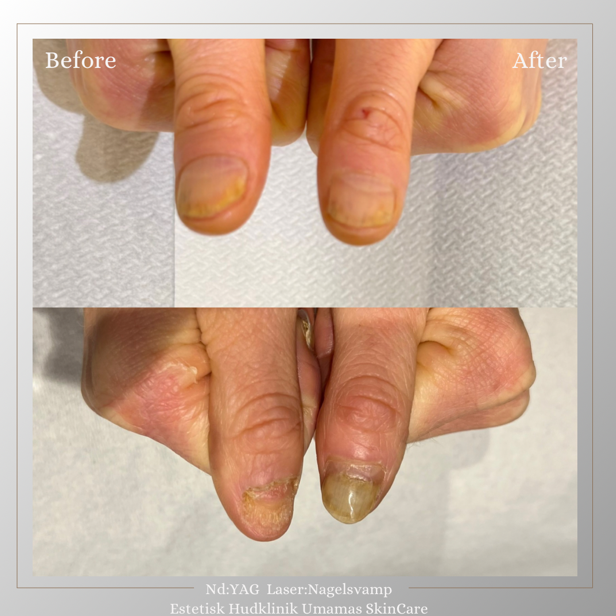 Före- och efterbild efter behandling av nagelsvamp