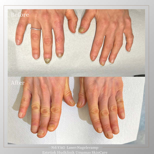 Före- och efterbild efter behandling av nagelsvamp