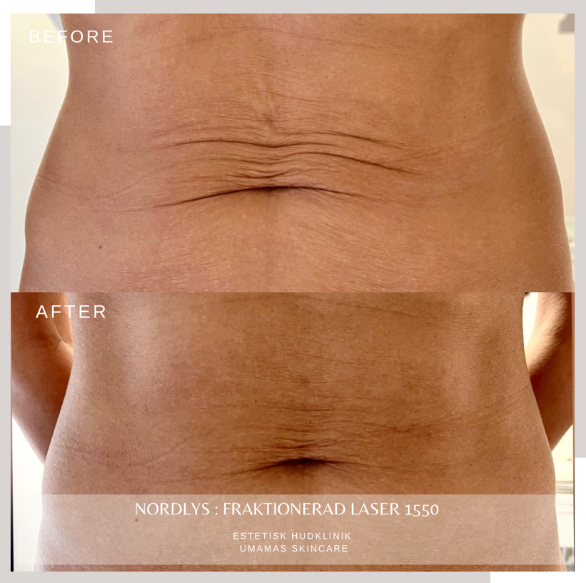 Fraktionerad laser - mage
