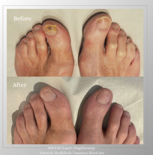 Nagelsvamp före & efter